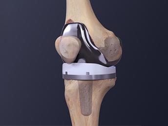 Joint Replacement Services In Siliguri